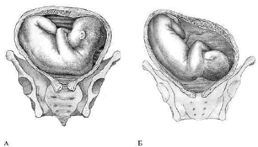 Роды в тазовом предлежании