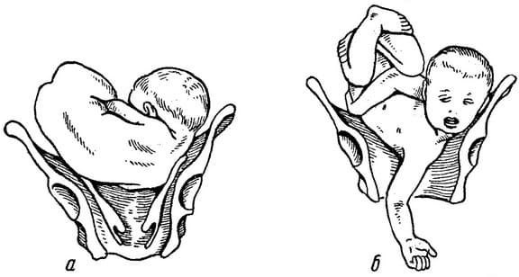 Поперечное и косое предлежание плода Поперечное и косое предлежание плода