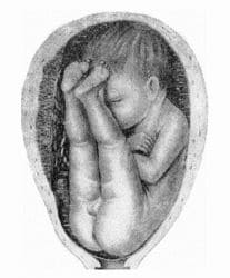 Тазовое предлежание плода: ягодичное Тазовое предлежание плода: ягодичное