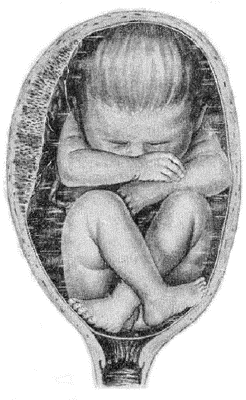 Тазовое предлежание плода: смешанное Тазовое предлежание плода: смешанное