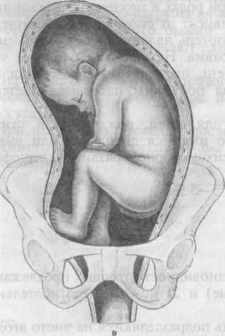 Тазовое предлежание плода: ножное Тазовое предлежание плода: ножное