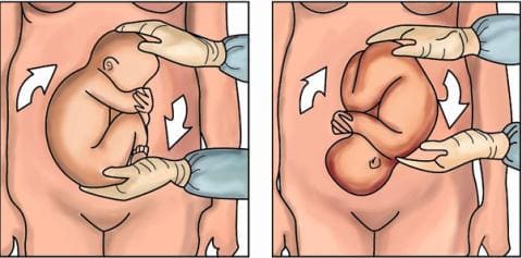 Этапы наружного поворота по Архангельскому Этапы наружного поворота по Архангельскому