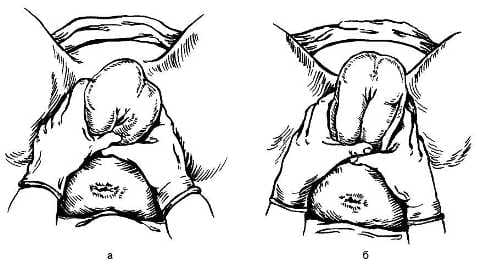 Роды в тазовом предлежании Роды в тазовом предлежании