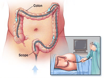 Колоноскопия под наркозом