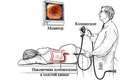 Колоноскопия (исследование кишечника)