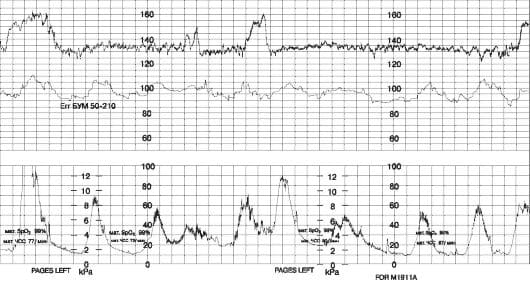 Кардиотокография (КТГ) при беременности
