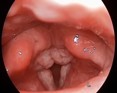Хронический ларингит
