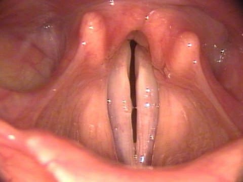 Стеноз гортани