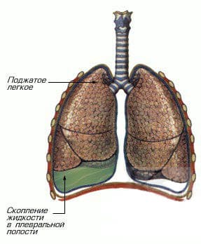 Схематическое изображение правостороннего экссудативного плеврита