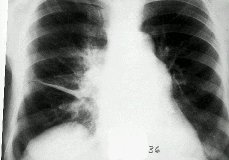 Рентгенография легких при фибринозном плеврите