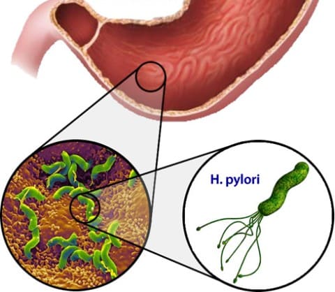 Хеликобактер пилори - одна из причин гастрита