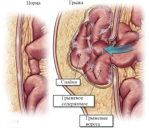 Грыжи передней брюшной стенки