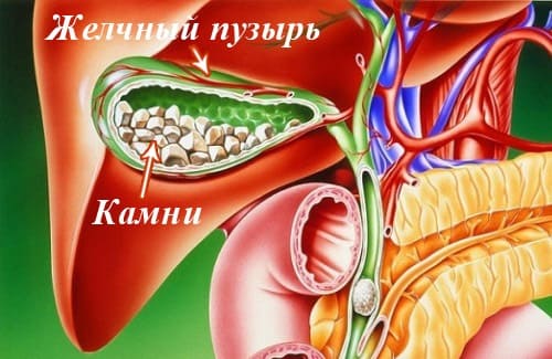 Камни в желчном пузыре