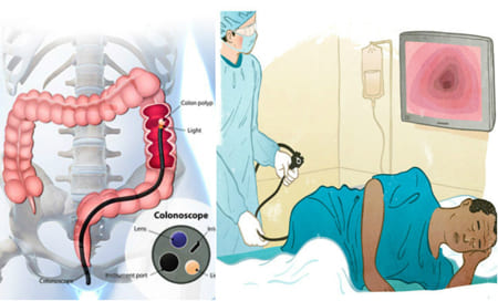 Колоноскопия