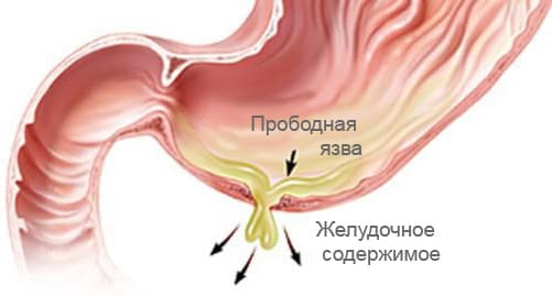 Прободная язва 