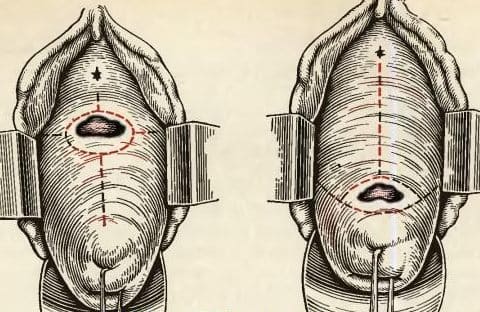 Мочеполовые свищи у женщин