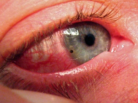 Непроникающее ранение глаза