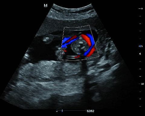 Эхинококкоз печени на УЗИ