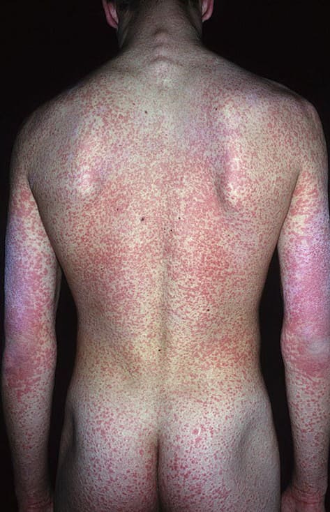 Энтеровирусная экзантема Энтеровирусная экзантема