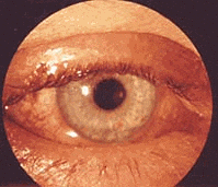 Геморрагический конъюктивит
