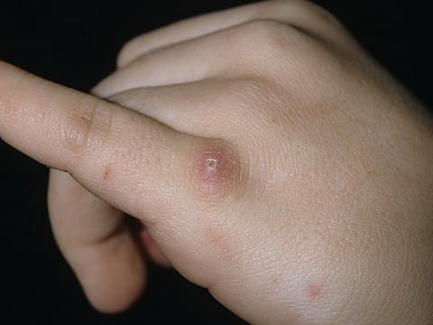 Первичный аффект при фелинозе