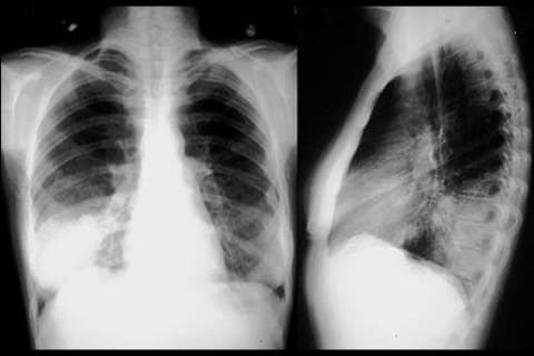 Гемофильная пневмония