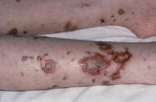 Гемофильный сепсис