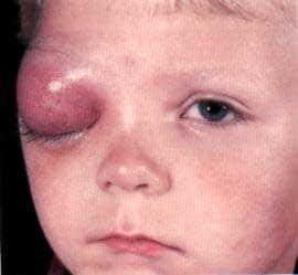 Гемофильная инфекция