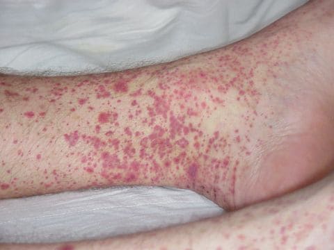 Геморрагическая сыпь при ГЛПС