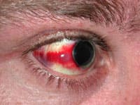 Кровоизлияние в склеры