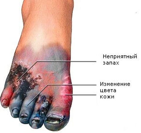 Газовая гангрена