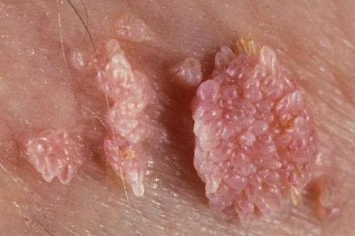 Папилломавирусная инфекция (ПВИ) Папилломавирусная инфекция (ПВИ)