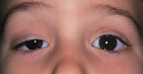 Птоз век при менингоэнцефалите