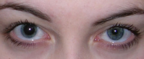 Анизокория при менингоэнцефалите Анизокория при менингоэнцефалите