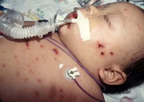 Менингококковая инфекция Менингококковая инфекция