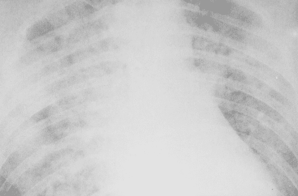 Респираторный дистресс-синдром