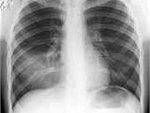 Пневмококковая инфекция