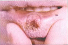 Шанкр на губе Шанкр на губе