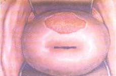 Шанкр на шейке матки Шанкр на шейке матки