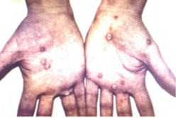 Шелушащиеся сифилитические папулы на ладонях Шелушащиеся сифилитические папулы на ладонях