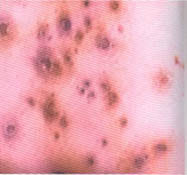 Пустулезные сифилитические папулы Пустулезные сифилитические папулы