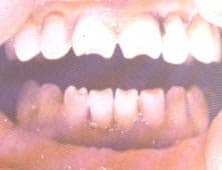 Поздний врождённый сифилис Поздний врождённый сифилис