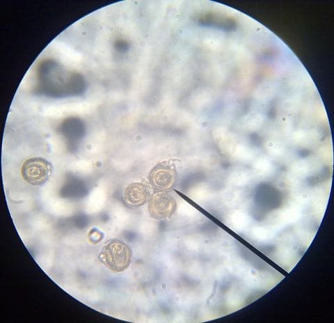 Тениоз (свиной цепень)