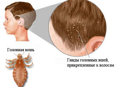 Гниды на коже головы схематично Гниды на коже головы схематично