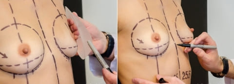 Увеличение груди