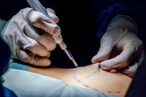 Увеличение груди