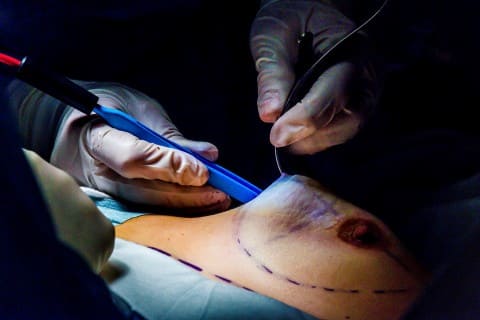 Увеличение груди