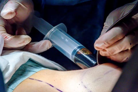 Увеличение груди