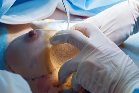 Увеличение груди