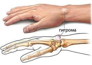 Схематическое изображение гигромы